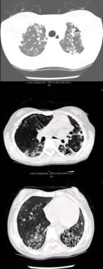 Axial CT scan of the chest of a 15-year-old female