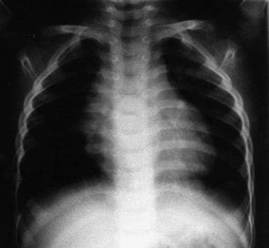 Infundibular Pulmonary Stenosis. Chest radiograph 