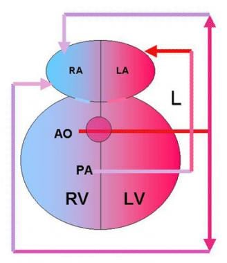 Double Outlet Right Ventricle Surgery. Double outl