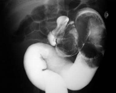 Barium enema shows intussusception in the descendi