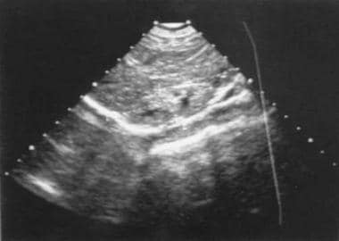 Renal sonogram of an infant with congenital chlori