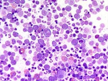 Pediatric Polycythemia Vera: Background, Pathophysiology 