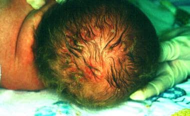 Vesicular scalp lesions caused by herpes simplex v