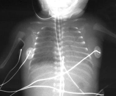 Anteroposterior chest radiograph in an infant born