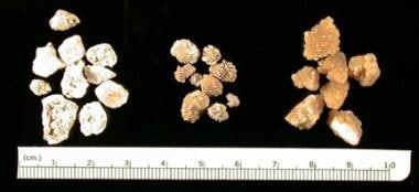 Three groups of kidney stones are shown. Groups at