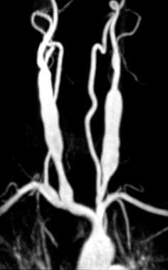 Magnetic resonance angiogram (MRA) in the same pat