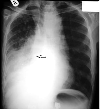 Moderate to severe right-sided aspiration pneumoni