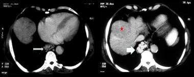 Axial contrast-enhanced CT scans in the portal ven