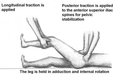 posterior hip dislocation presentation