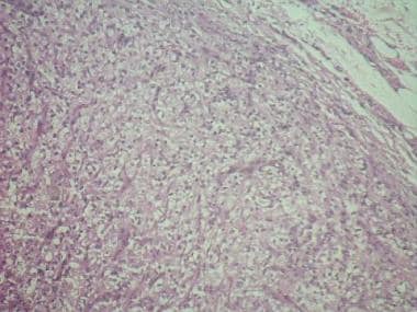 A well-circumscribed metastasis of renal cell carc