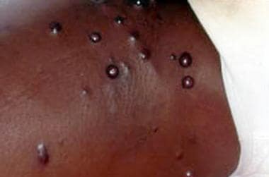 Kaposi sarcoma in a man with HIV infection. 