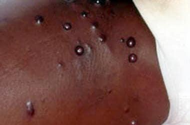 acute hiv rash chest