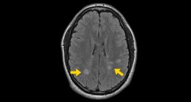 Cranial MRI study showing typical white matter les