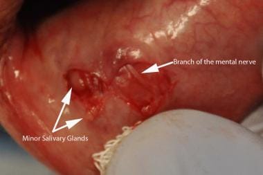 Minor salivary glands seen in situ. A branch of th