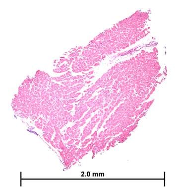 tissue rejection