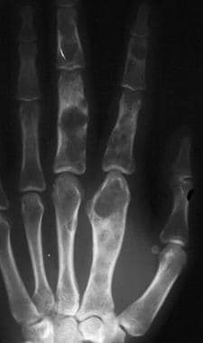 chondroma in knee x ray