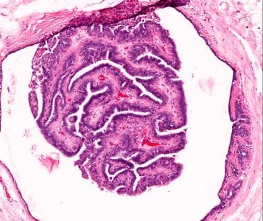 intraductalis papilloma medscape