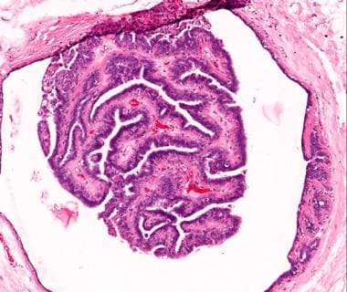 intraductal papilloma immunohistochemistry