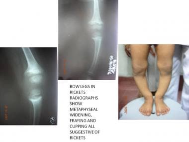 Bowed tibia as result of rickets. 