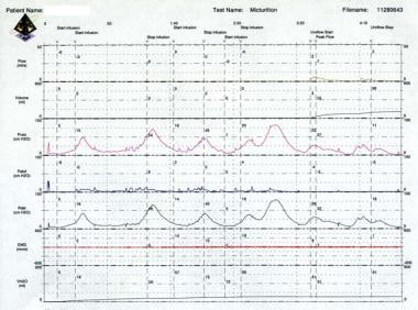 Urodynamic Testing Procedure