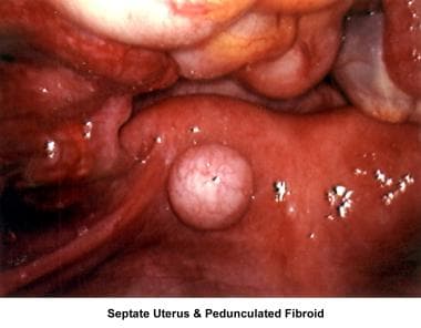 Infertility. Septate uterus and pedunculated fibro