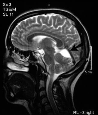 T2-weighted sagittal MRI image (see next image for