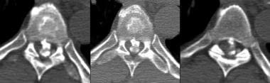 Axial CT myelogram of a large, central calcified d