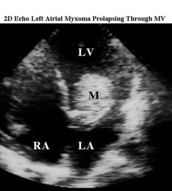 Apical 4-chamber 2-dimensional echocardiogram of a