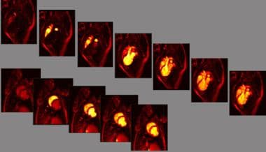 Contrast-labeled blood to the heart is used to ide