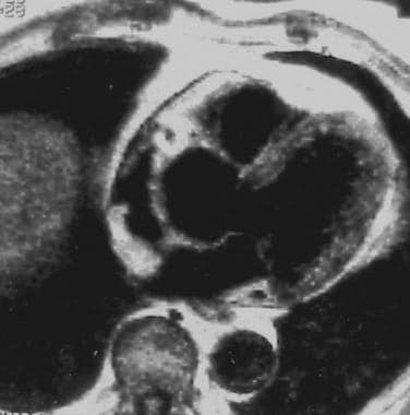 The uniqueness of cardiac magnetic resonance imaging in arrhythmogenic  right ventricular cardiomyopathy