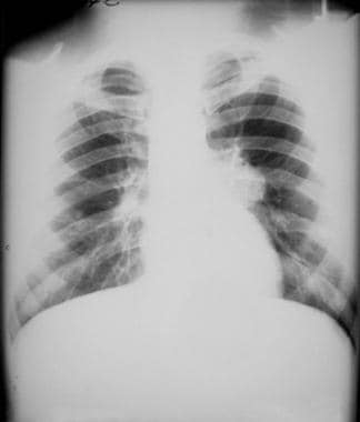 Chest radiograph from a patient with blastomycosis