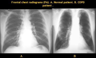 A, Frontal posteroanterior (PA) chest radiograph s