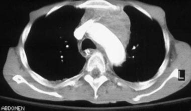 Image in a 40-year-old man with HIV disease. Chest