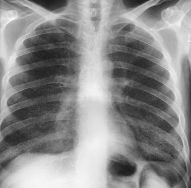 This radiograph depicts a diffuse, fine, reticular