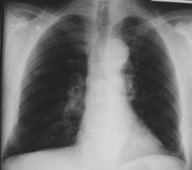 Solitary pulmonary nodule. Findings show a right-s