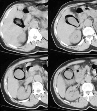 CT images of emphysematous cholecystitis. 