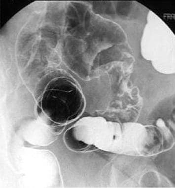 Annular carcinoma of the sigmoid colon. The lumen 