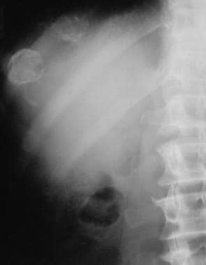 A plain abdominal radiograph of the right upper qu