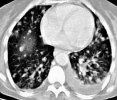 Pulmonary metastases and left pleural effusion fro