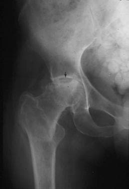 An anteroposterior pelvic radiograph of a patient 