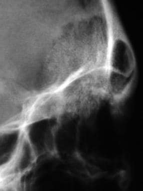 Bone hemangioma. Lateral projection in the same pa