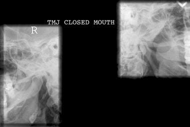 Closed-mouth lateral radiographic view of both con