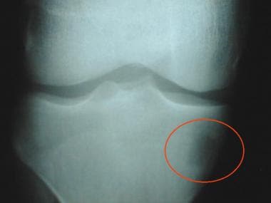 Knee radiograph from a 16-year-old boy with lower 