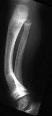 Lateral radiograph of the leg in a child with chro