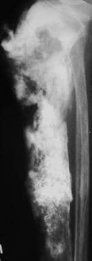 Lateral radiograph of the tibia in a patient with 