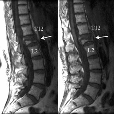 Lumbar spine trauma. Sagittal T1-weighted MRI of t