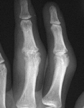 Which Findings On Radiography Are Characteristic Of Rheumatoid Arthritis Ra In The Hands