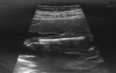 trisomy 21 ultrasound