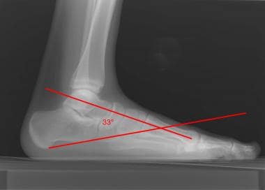 Normal lateral view shows the measurement of the t