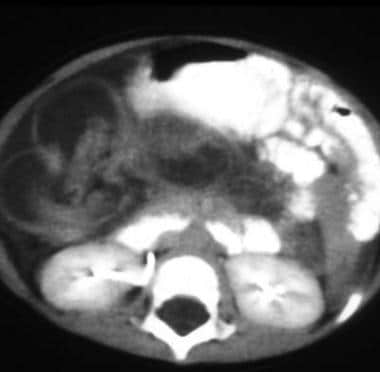 Computed tomography (CT) scanning is not indicated